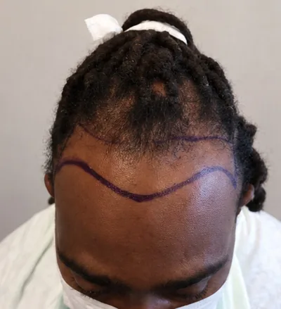 Avant la greffe capillaire, cheveux de type afro