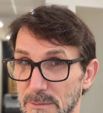 Après la greffe capillaire, cheveux clairsemés