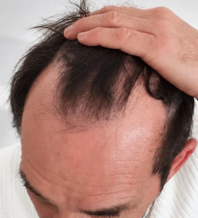 Avant la greffe capillaire, cheveux clairsemés
