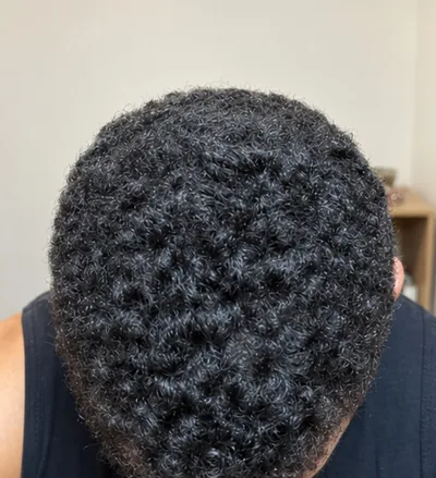 Après la greffe capillaire, cheveux crépus