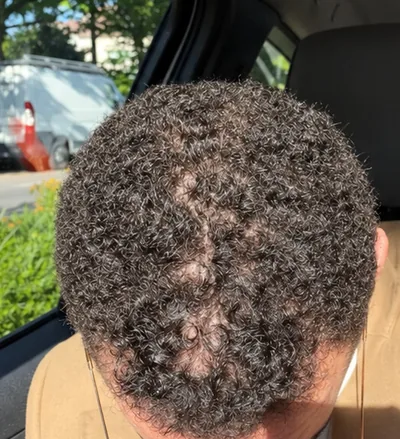 Avant la greffe capillaire, cheveux crépus