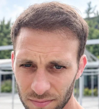 Après la greffe capillaire, homme au crâne rasé