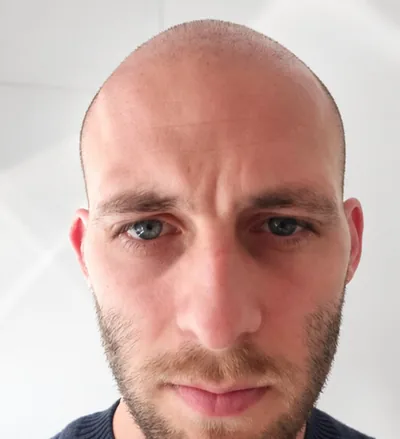 Avant la greffe capillaire, homme au crâne rasé