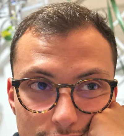 Avant la greffe capillaire, densité frontale