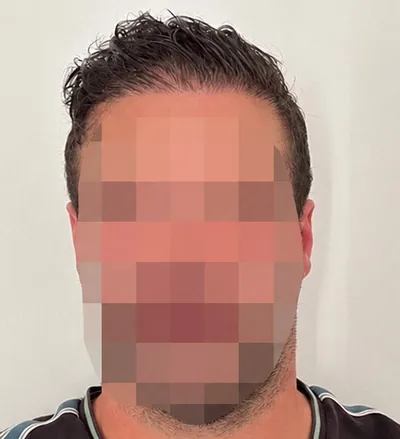 Après la greffe capillaire, patient au visage flouté
