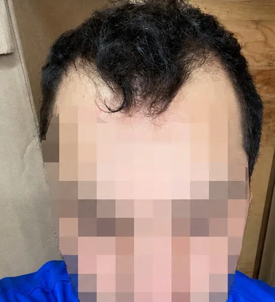 Avant la greffe capillaire, patient au visage flouté