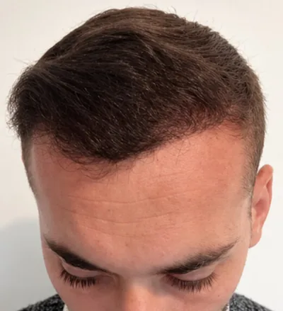 Après la greffe capillaire, recul frontal