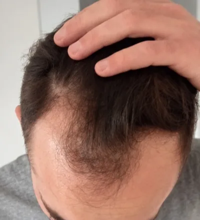 Avant la greffe capillaire, recul frontal