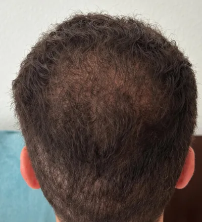 Après la greffe capillaire, zone de la tonsure