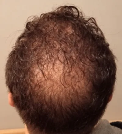 Avant la greffe capillaire, zone de la tonsure