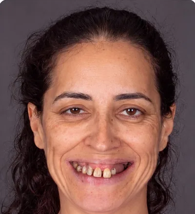 Avant les soins dentaires, femme brune aux dents colorées et irrégulières