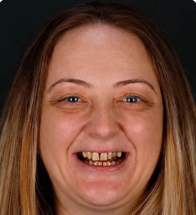 Avant les soins dentaires, femme aux dents abîmées et colorées