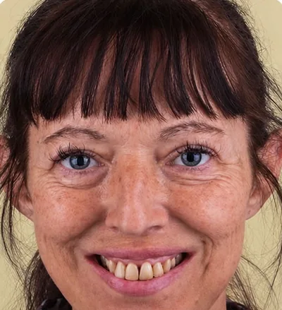Avant les soins dentaires, femme aux dents jaunies