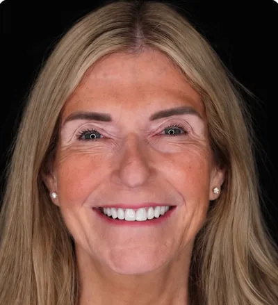 Après les soins dentaires, femme senior aux dents irrégulières