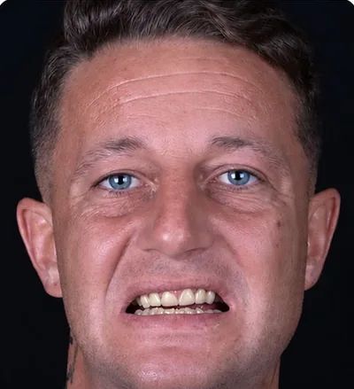 Avant les soins dentaires, homme aux dents abîmées