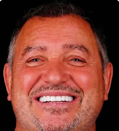 Après les soins dentaires, homme avec plusieurs dents manquantes