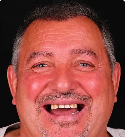 Avant les soins dentaires, homme avec plusieurs dents manquantes