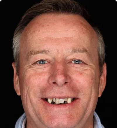Avant les soins dentaires, homme senior avec des dents manquantes